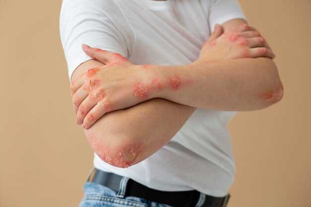 Эффективные методы лечения аллергии на руках
