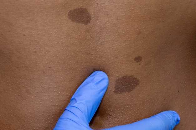 Причины возникновения кератоза кожи