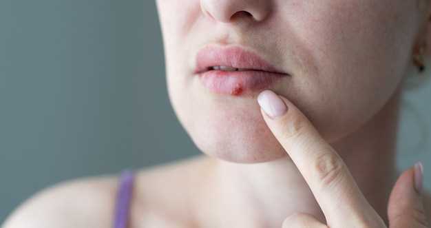 Методы лечения простуды на уголках губ: