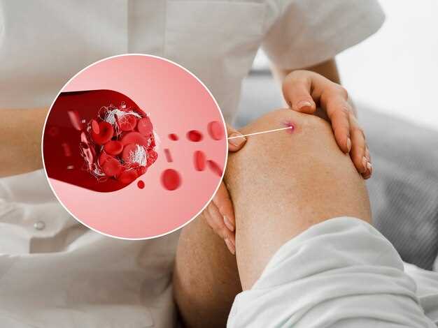 Лечение субарахноидального кровоизлияния